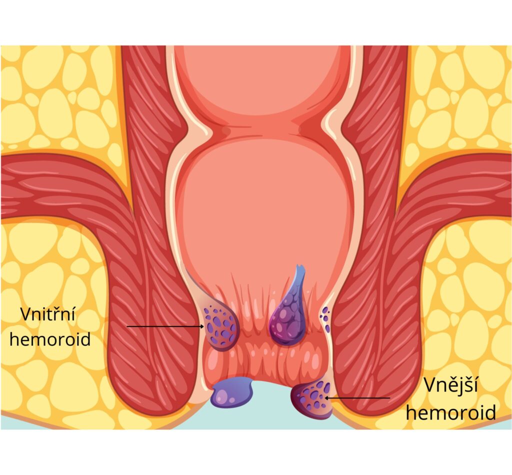 Umístění vnějších a vnitřních hemoroidů